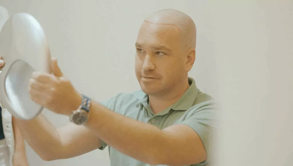 Reconstructive Hair Transplant