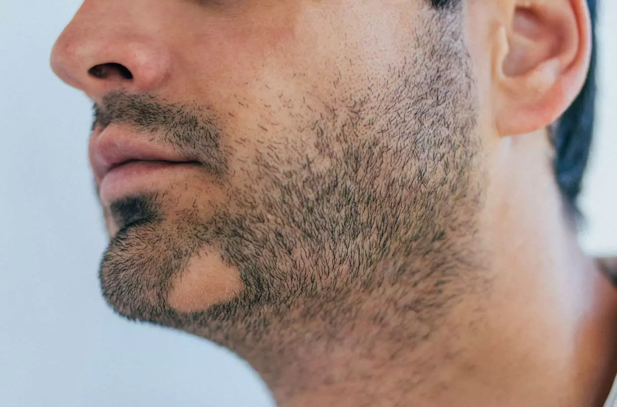 Hair disease - Alopecia Areata