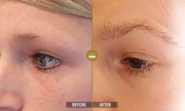 Eyebrow hair transplant2