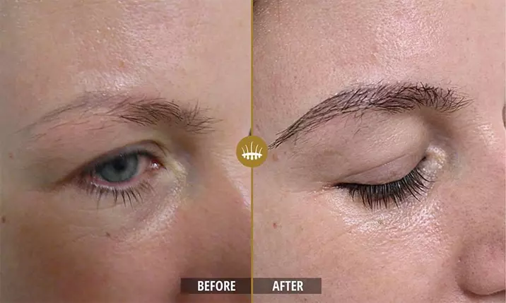 Eyebrow hair transplant1