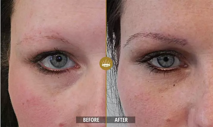 Eyebrow hair transplant4