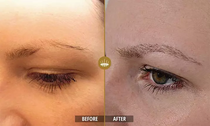 Eyebrow hair transplant3