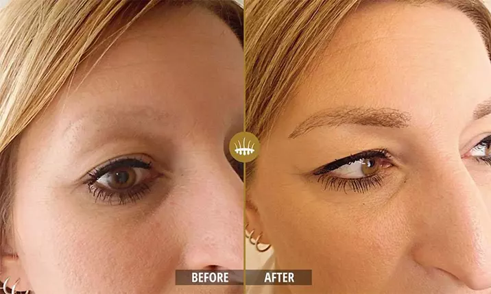 Eyebrow hair transplant5