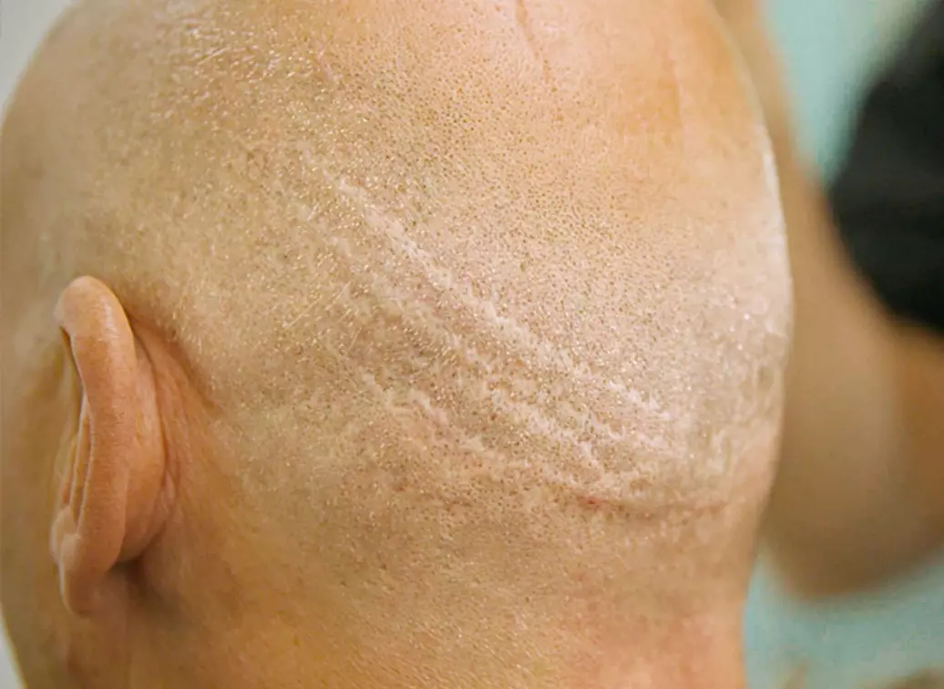 HST For Scars & Burns