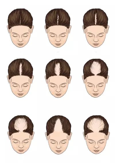 Patterns of baldness1